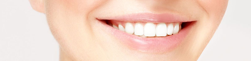 veneers